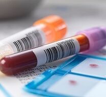 Diagnostic de laboratoire de prostatite