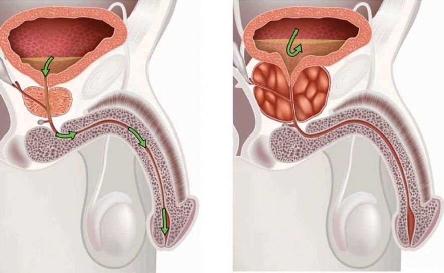 prostate saine et enflammée