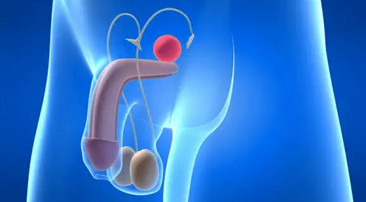 La prostatite est une inflammation de la prostate chez l'homme, qui nécessite un traitement complexe